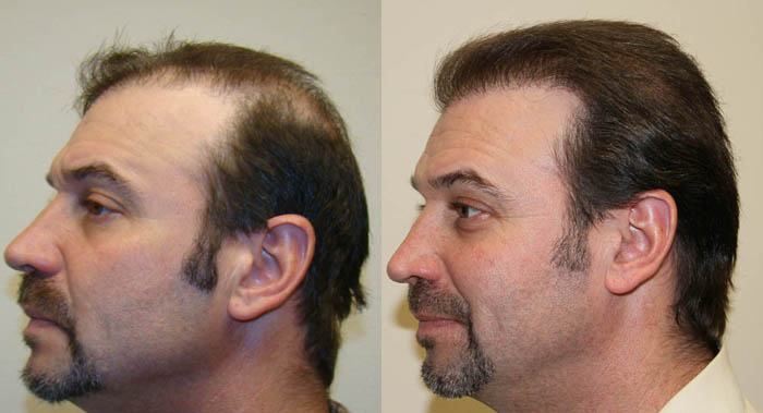 Hair-Transplant-Before-and-After2.jpg