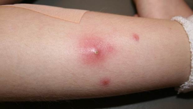 staph-infection-causes-and-symptoms-skin-hair-problems-articles