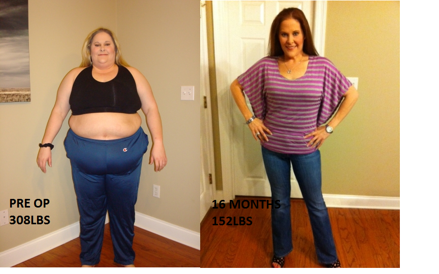 gastric sleeve success stories